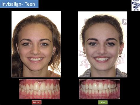 phub braces|Google.